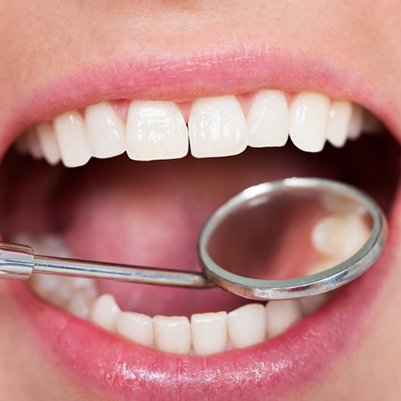Teeth are examined with dental mirror
