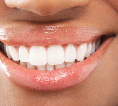 Closeup of patient with dental bonding in Frisco smiling