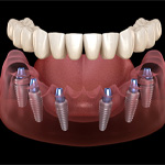 implant dentures representing cost of dentures in Frisco