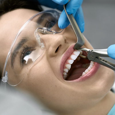 Dentist performing simple extraction on woman’s tooth