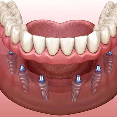 Dentures being attached to dental implants in Frisco, TX