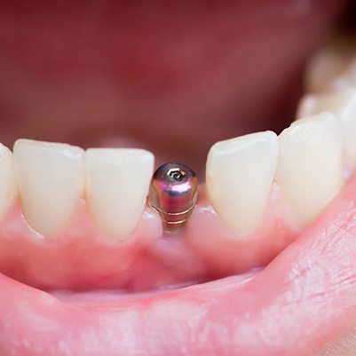 closeup of dental implant in patient’s mouth 