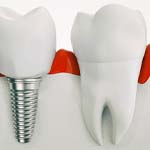 Model of single dental implant in Frisco, TX next to natural tooth