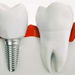 Model of single dental implant in Frisco, TX next to natural tooth