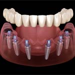 Six dental implants in Frisco, TX with denture