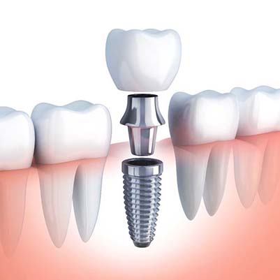 model of how dental implants in Frisco, TX work