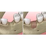 a jawbone before and after bone grafting