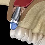 a dental implant in the upper jaw