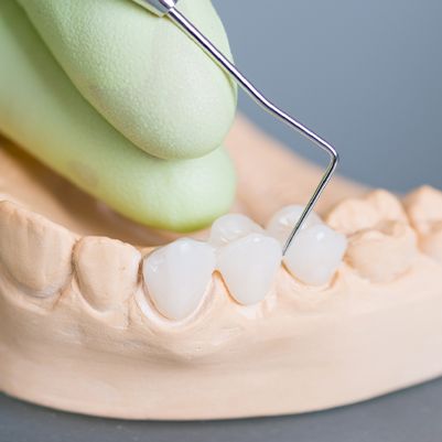 Model smile with dental bridge restoration