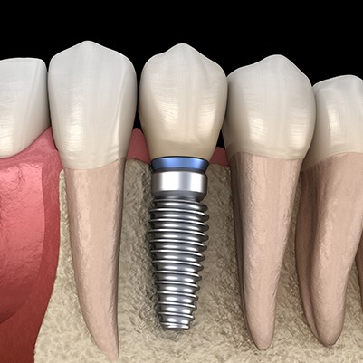 Animated implant supported dental crown