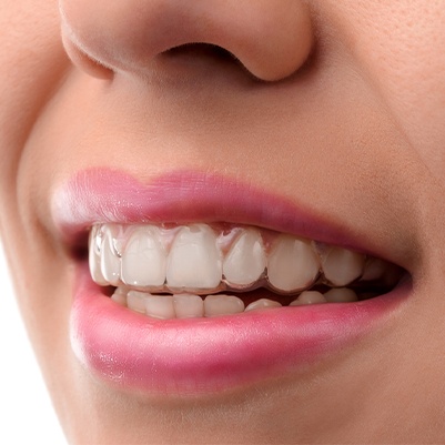 Closeup of patient with Invisalign trays in place