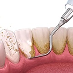 Illustration of tool being used to scale teeth