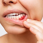 Woman pulling lip down to reveal signs of gum disease