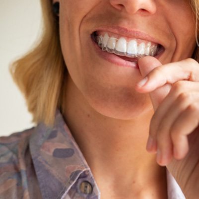 Woman putting in SureSmile aligners