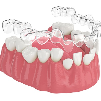 Illustration of clear aligner being placed on lower row of crooked teeth