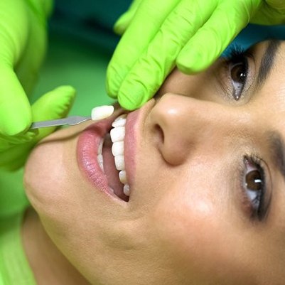 cosmetic dentist in Frisco placing veneers on woman