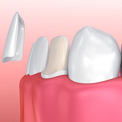 diagram of veneer being placed on tooth