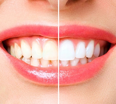 Closeup of before and after of teeth whitening treatment